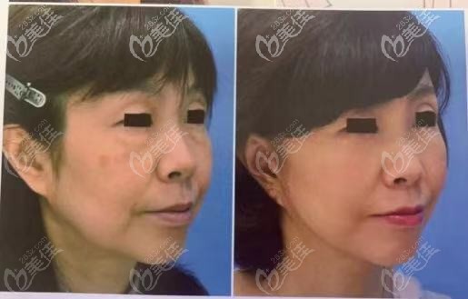 曝韩国拉菲安LAVIAN面部大拉皮手术照片，效果保持8年之久