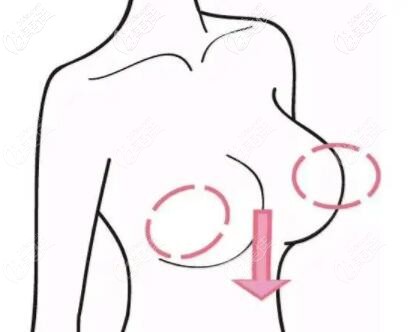 胸部下垂做乳房悬吊提升手术风险大吗