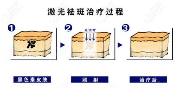 激光祛斑治疗过程 激光祛斑治疗过程