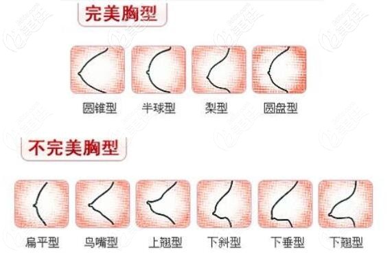 哪些胸型需要做隆胸手术 哪些胸型需要做隆胸手术