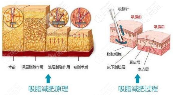 吸脂减肥原理与过程 吸脂减肥原理与过程