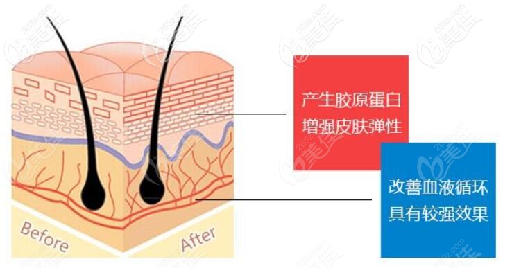 面部埋线提升手术特点示意图