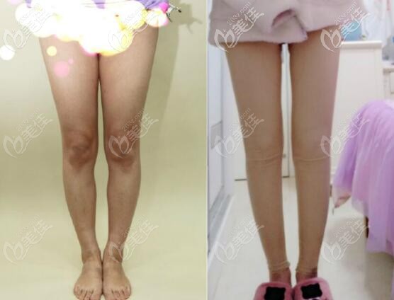 北京达美如艺罗圈腿矫正案例两个月真实效果对比图