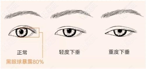 上睑下垂矫正 上睑下垂矫正