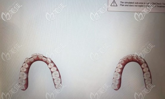 口扫可提前预知矫正<span style=