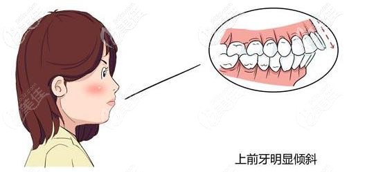 肌激动器和twinblock矫正器的适应病例