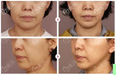 新疆黎美脸部热玛吉效果图 新疆黎美脸部热玛吉效果图