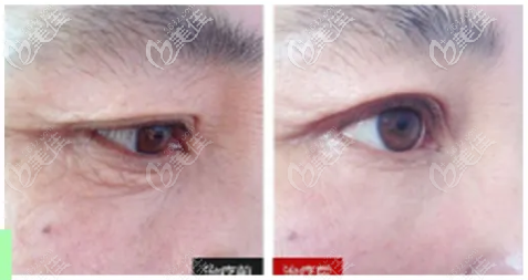 两张新疆黎美脸部热玛吉提升+去皱效果图，包括眼部