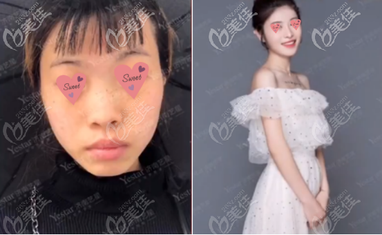 四号求美者的案例图片以及真实评价 四号求美者的案例图片以及真实评价