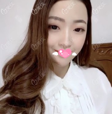 <!--<i data=20240703-sp></i>-->整形医院全脸脂肪田填充第7天图片