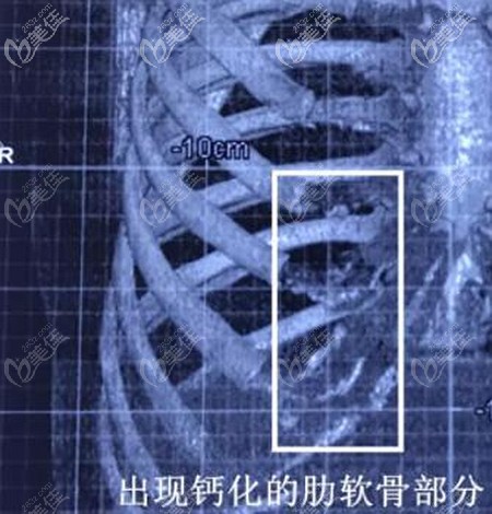肋软骨钙化的轻重程度 肋软骨钙化的轻重程度