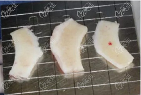 肋软骨点状钙化图片 肋软骨点状钙化图片