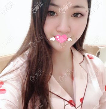 面部脂肪填充第3天的恢复图