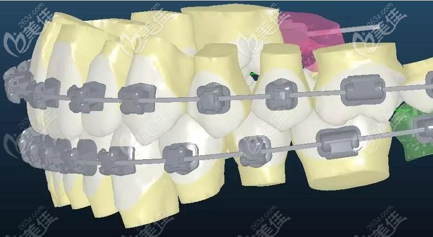 金属自锁托槽矫正展示图