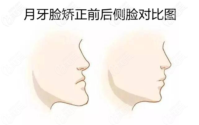 月牙脸矫正前后对比