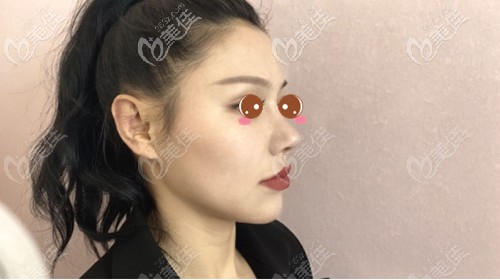 耳软骨隆鼻失败4个月后来做了修复，术后鼻尖一改之前又大又圆之态