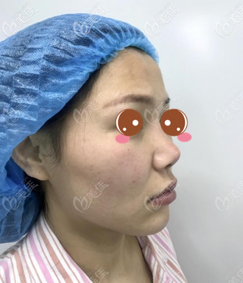 耳软骨隆鼻修复前 耳软骨隆鼻修复前