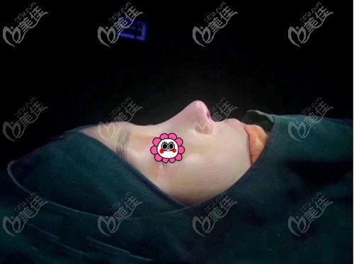 耳软骨隆鼻失败修复前后 耳软骨隆鼻失败修复前后