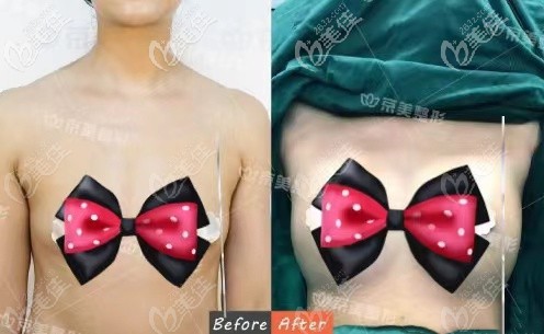 自体脂肪隆胸300cc是多大