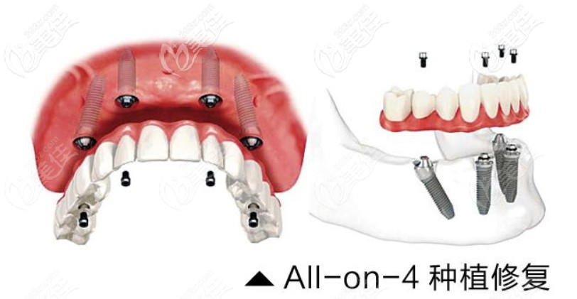 Allon4种植牙技术