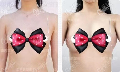 自体脂肪丰胸术后5年的对比照片