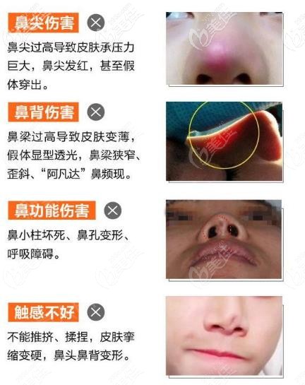 六安菲凡隆鼻手术杜绝鼻尖压力、鼻背皮肤变薄等情况