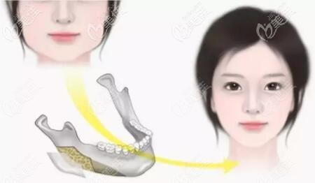 下颌角整形术全过程是怎么做的