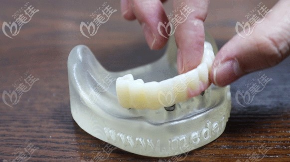 allon4半口种植牙模型