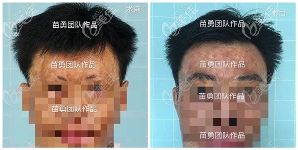 广州荔医苗勇医生的植眉案例效果图:含疤痕/男,女士眉毛种植的对比照片