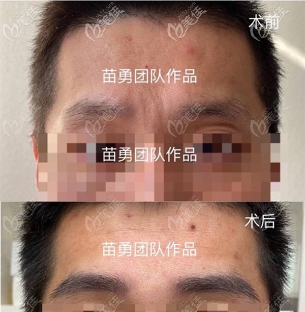 广州荔医男士眉毛种植前后的对比照片