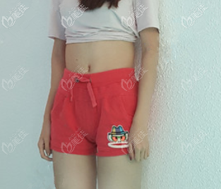 做威塑腰腹环吸前 做威塑腰腹环吸前