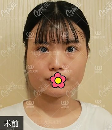 杭州连天美医院高俊明医生下颌角截骨前