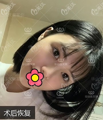 长曲线下颌角截骨四个月效果