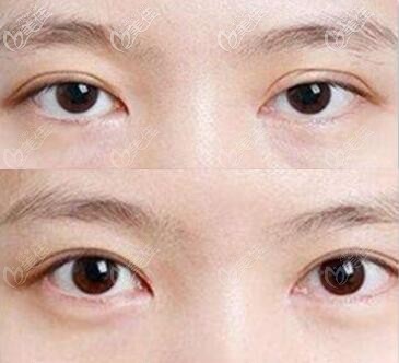 真人双眼皮修复前后对比照片 真人双眼皮修复前后对比照片