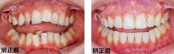 矫正前后对比