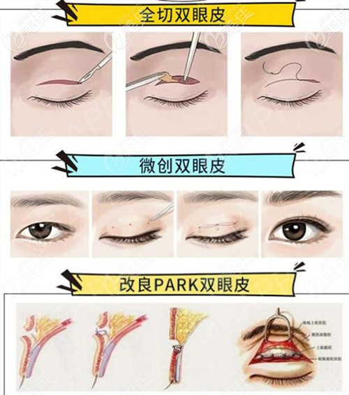 玉林华美双眼皮方法 玉林华美双眼皮方法