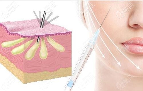 自体脂肪面部填充 自体脂肪面部填充