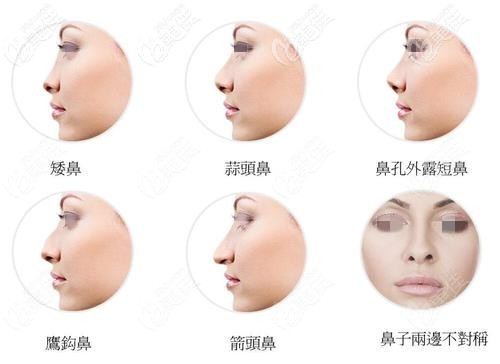 各种鼻部问题 各种鼻部问题