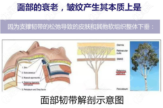 面部韧带解剖示意图