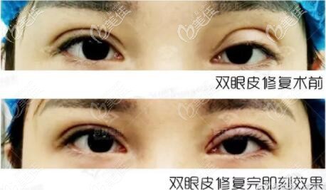 双眼皮修复前后真人对比图片 双眼皮修复前后真人对比图片