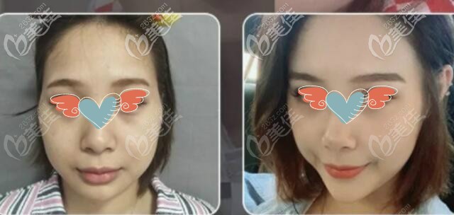 面部脂肪加减法真实案例术前术后对比效果图 面部脂肪加减法真实案例术前术后对比效果图