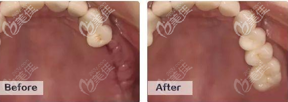 广州中家医家庭口腔医院免费种植牙怎么样