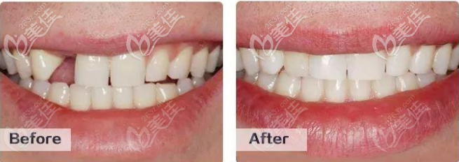 广州中家医家庭口腔种植牙怎么样