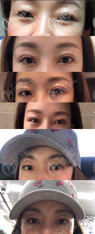 广州华美医疗美容整形医院郝永生术前照片1