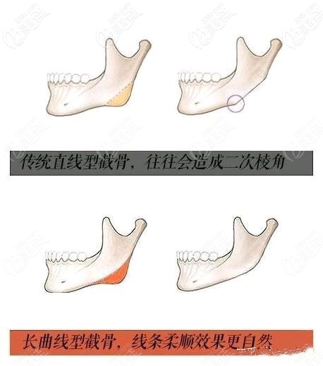 长曲线下颌角和普通下颌角的区别