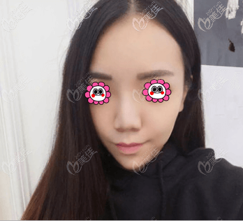 我在北京英煌做鼻子前 我在北京英煌做鼻子前