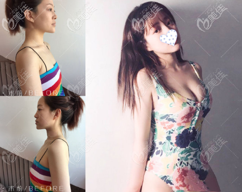 LZ自体生长脂肪细胞丰胸效果图