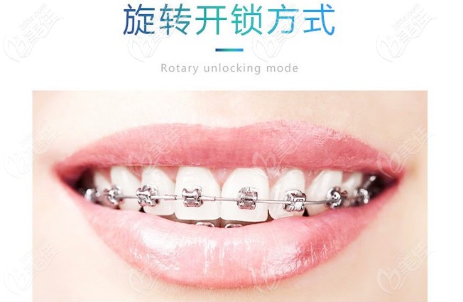 金属自锁托槽牙套