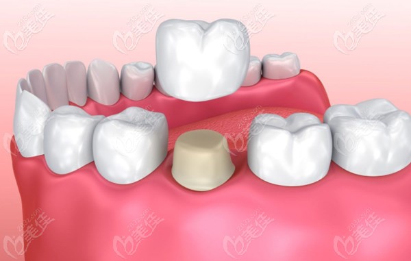 全瓷牙冠的安装示意图
