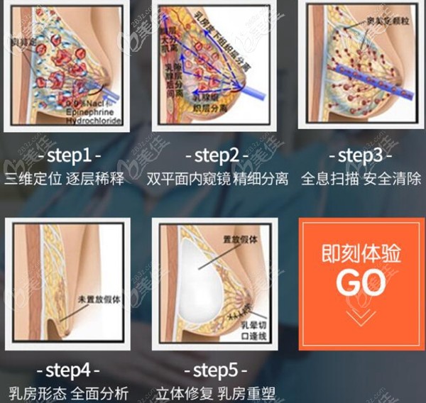 武汉仁爱时光包涛院长胸部奥美定取出 武汉仁爱时光包涛院长胸部奥美定取出